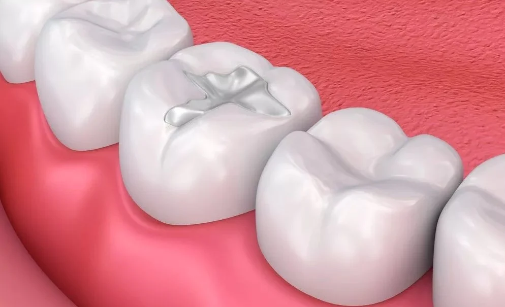 Amalgam Fillings