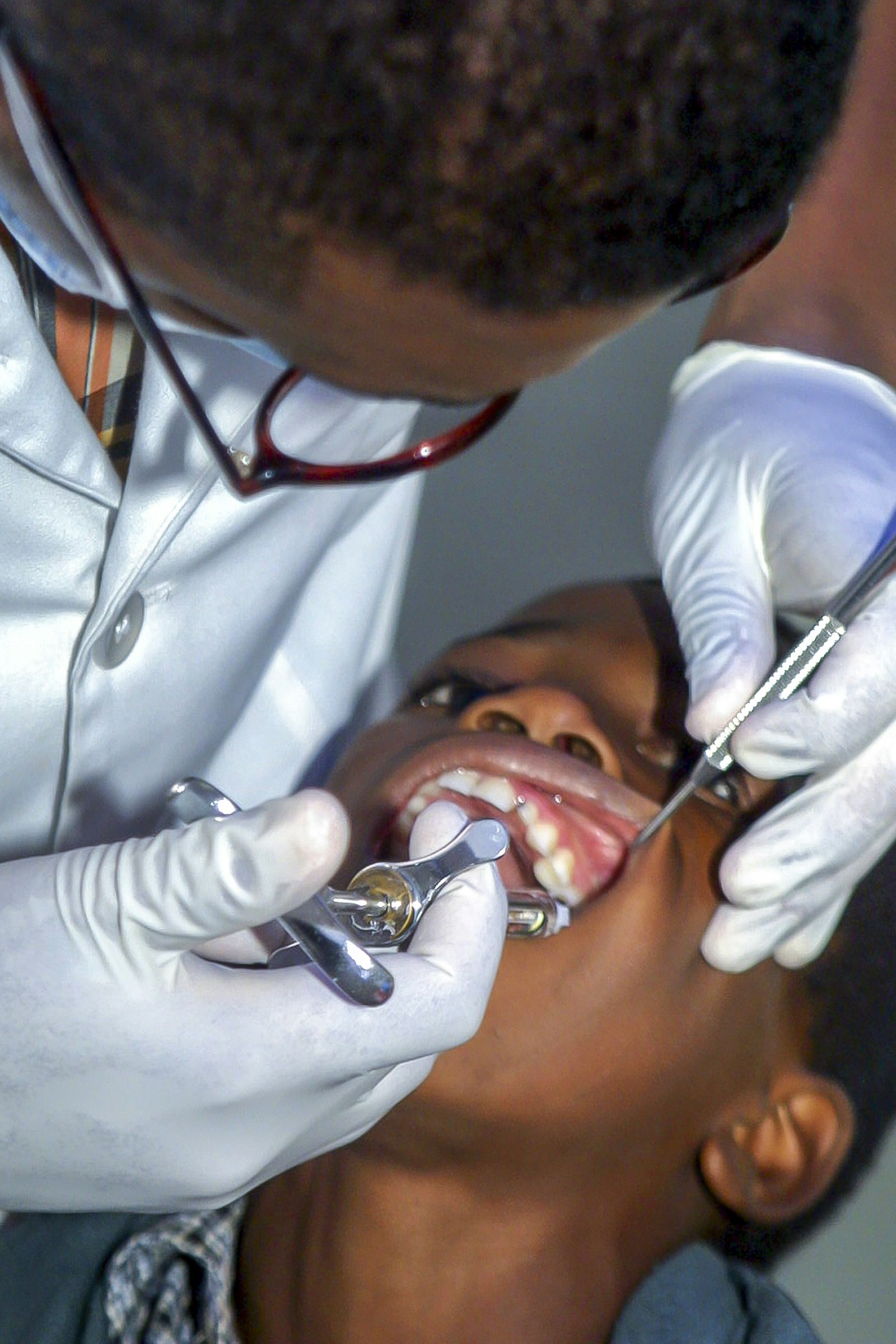 Broken or chipped teeth